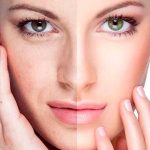 Шлях до бездоганної шкіри: як позбутися розширених порів на обличчі