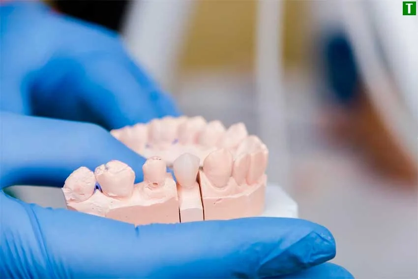 Імплантація – відновлення втраченого зуба