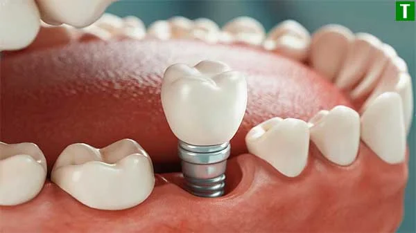 Рекомендації щодо догляду за зубами після імплантації