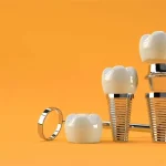 Переваги імплантації зубів