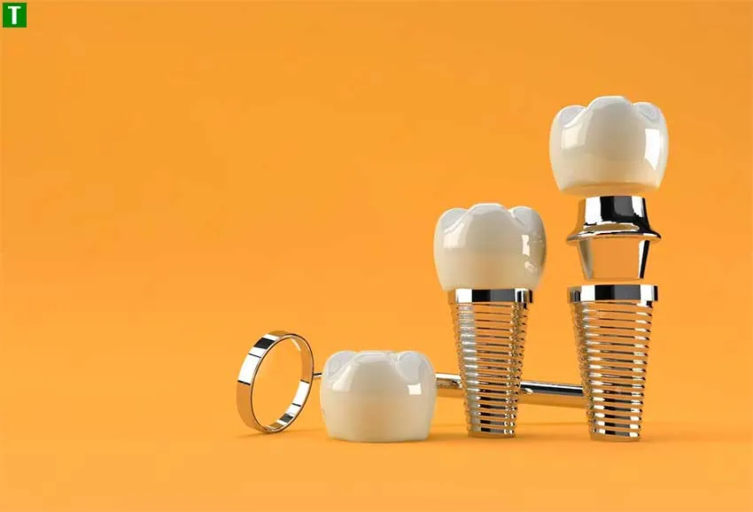 Переваги імплантації зубів