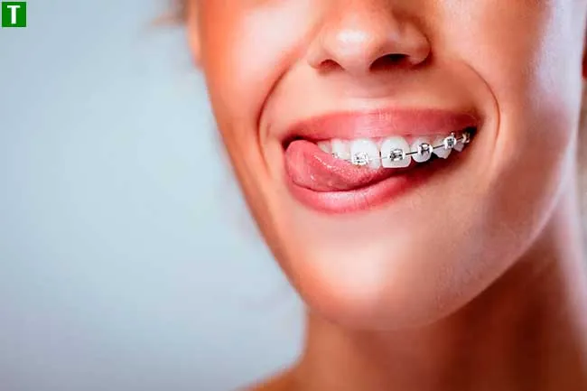 Что представляют собой самолигирующие брекеты от brillant.dental?