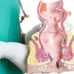 Геморрой или трещина как отличить