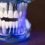 Як обрати зубні коронки