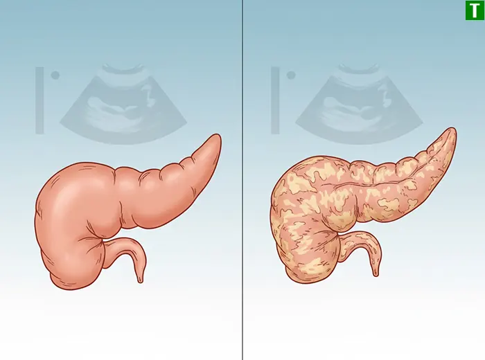 Дифузні зміни підшлункової залози